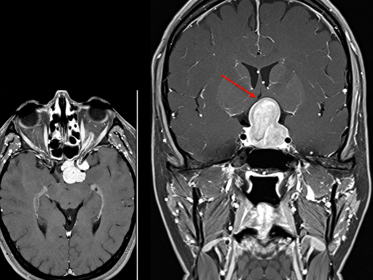 MRI showing the meningioma at the base of the brain, against the optic chiasm and pituitary